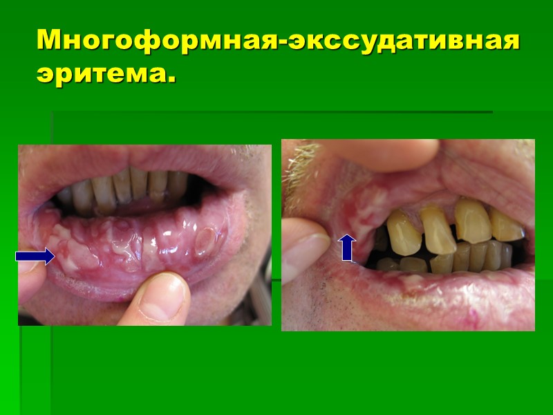 Многоформная-экссудативная эритема.